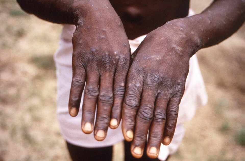 En kongolesisk mann viser fram hendene sine etter å ha blitt smittet av apekopper i 1997. I Afrika har det vært jevnlige utbrudd av sykdommen i flere tiår, men først nå, etter noen hundre tilfeller i vestlige land, har forskningen på sykdommen skutt fart. En kongolesisk mann viser fram hendene sine etter å ha blitt smittet av apekopper i 1997. I Afrika har det vært jevnlige utbrudd av sykdommen i flere tiår, men først nå, etter noen hundre tilfeller i vestlige land, har forskningen på sykdommen skutt fart. Foto: CDC via AP / NTB