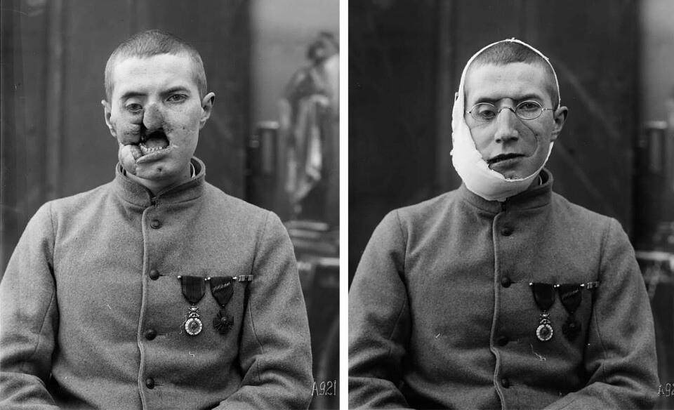 Før og etter-bilde av en av soldatene som fikk ansiktsmaske. Før og etter-bilde av en av soldatene som fikk ansiktsmaske. Foto: Library of Congress.