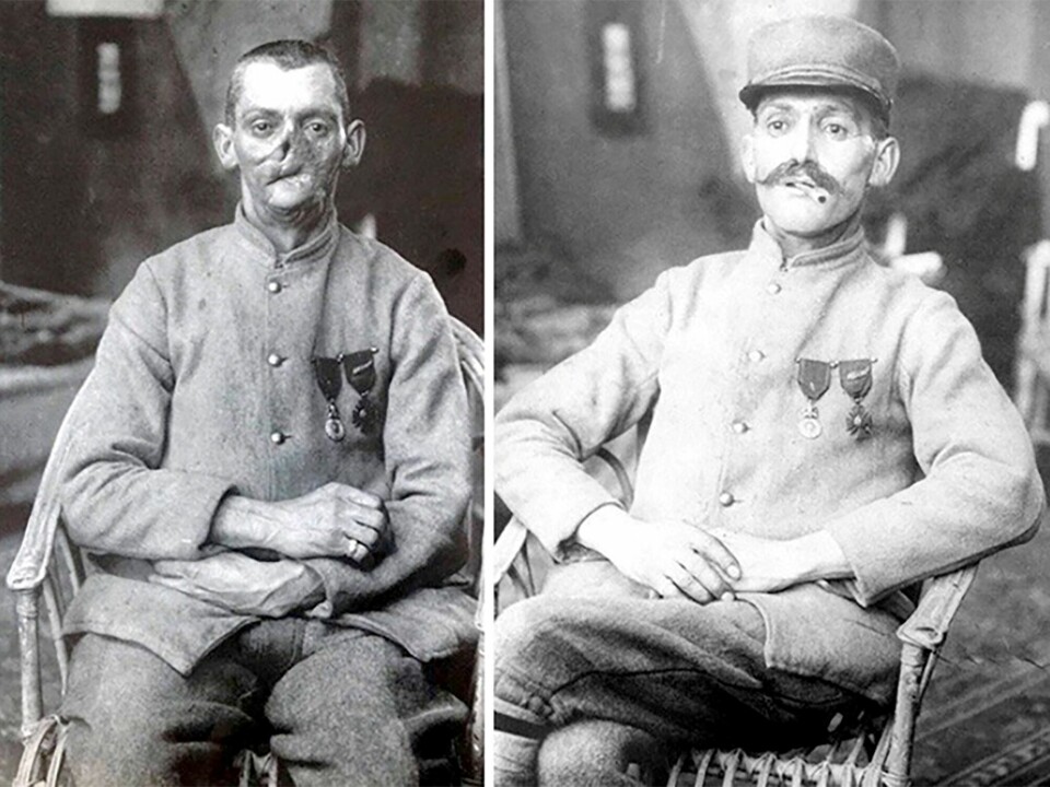 I blant var det vanskelig å skjønne at soldaten kunne overleve skadene. I blant var det vanskelig å skjønne at soldaten kunne overleve skadene. Foto: Library of Congress