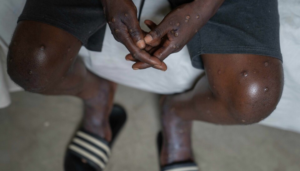 En mann med utbruddet mpox i Kongo. Det er få vaksiner mot sykdommen i Afrika. En mann med utbruddet mpox i Kongo. Det er få vaksiner mot sykdommen i Afrika. Foto: Moses Sawasawa / AP / NTB
