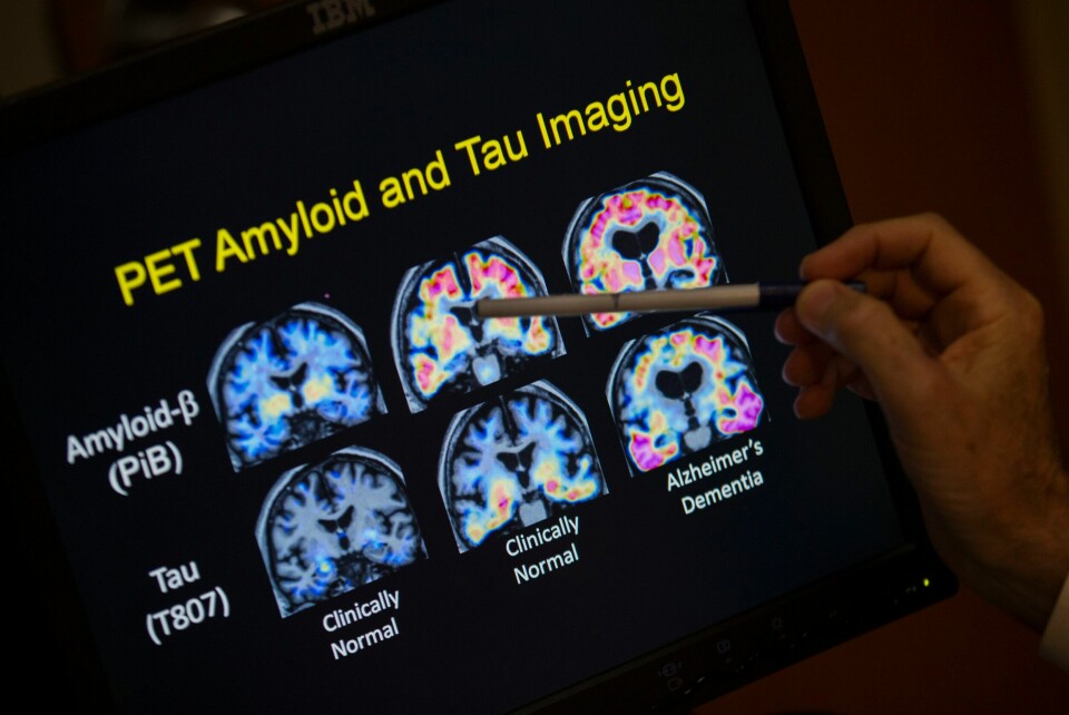 Alzheimers sykdom er bare en av flere nevrologiske sykdommer vi ikke har noe klart svar på enda. Et bilde av en hjernescan i forbindelse med Alzheimers sykdom.