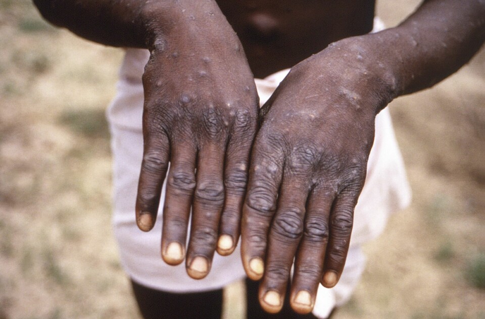 Bildet viser en person i Kongo med apekopper. Bildet viser en person i Kongo med apekopper. Foto: CDC via AP / NTB
