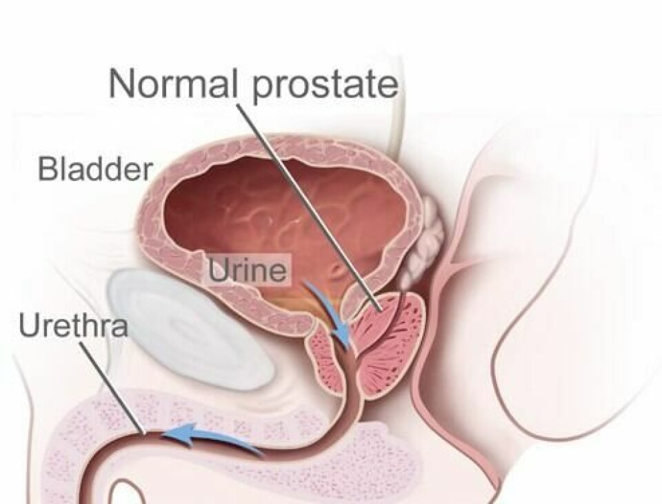 Prostatitt betyr at prostatakjertelen er betent, ofte forårsaket av en infeksjon. Prostatakjertelen ligger mellom blære og penis, like framfor endetarmen (rektum). Prostatitt betyr at prostatakjertelen er betent, ofte forårsaket av en infeksjon. Prostatakjertelen ligger mellom blære og penis, like framfor endetarmen (rektum).