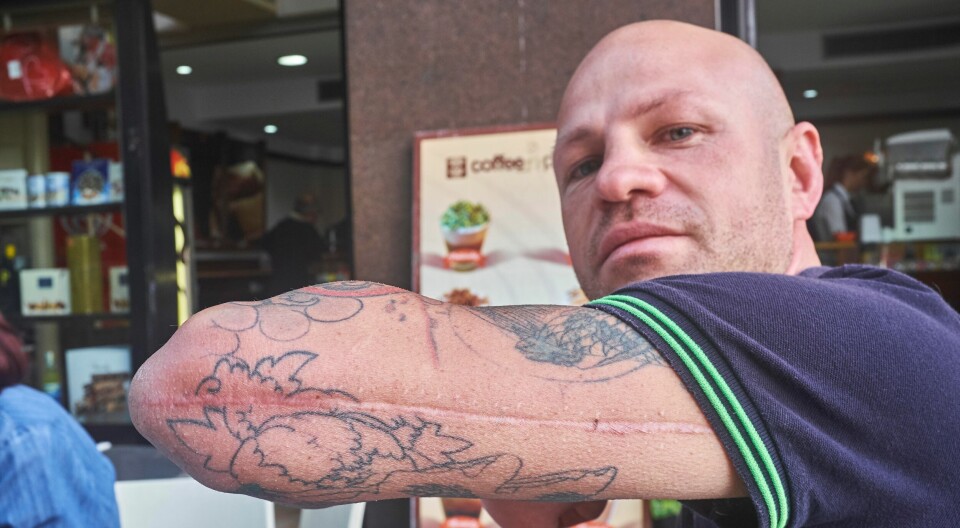 Salvatore Gabriele fra organisasjonen av eks-innsatte i Napoli viser fram arret han pådro seg da han falt fra øverste køye i den overbefolkede cella. Salvatore Gabriele fra organisasjonen av eks-innsatte i Napoli viser fram arret han pådro seg da han falt fra øverste køye i den overbefolkede cella.
